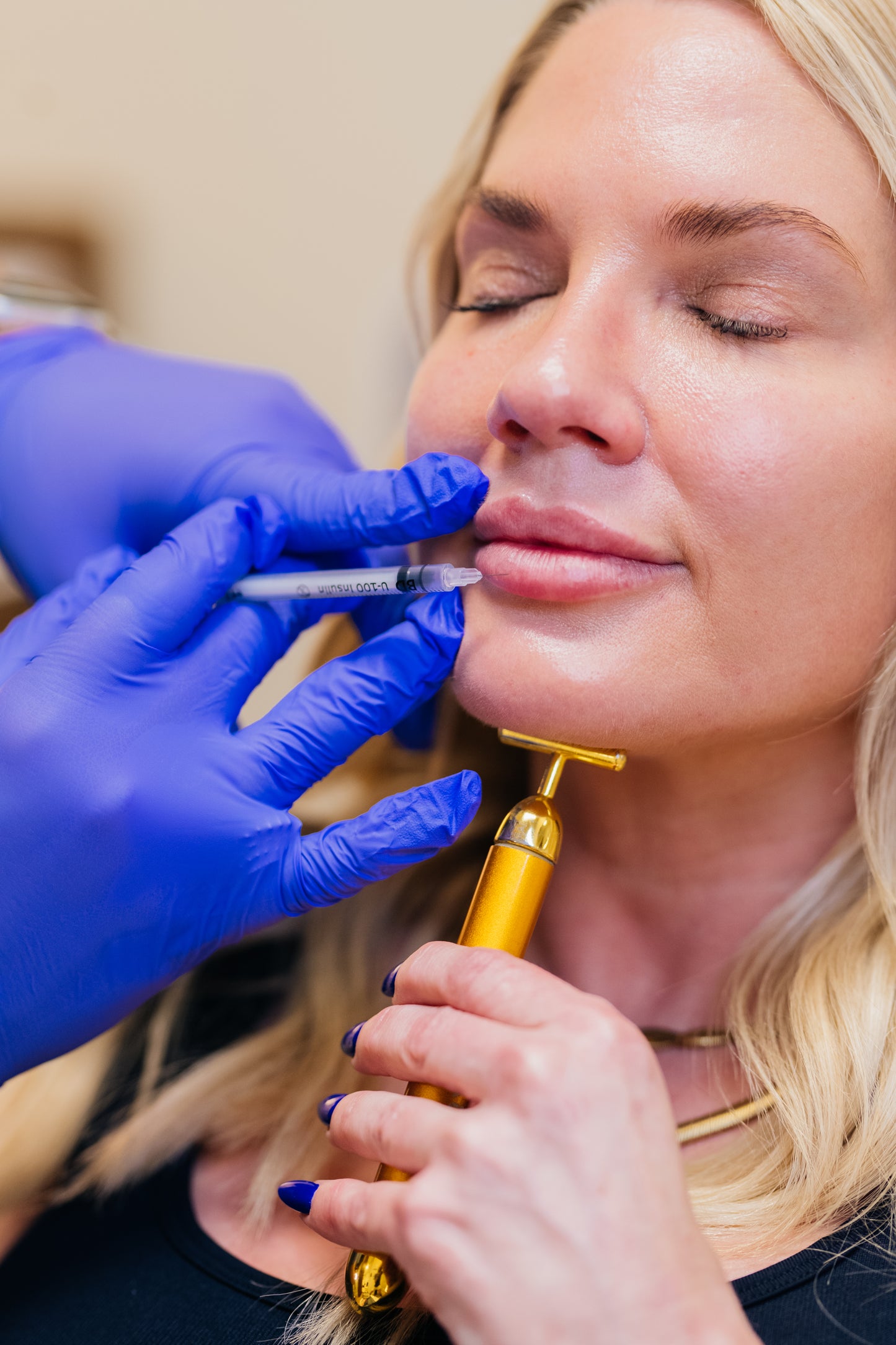 1 Syringe of Lip Filler